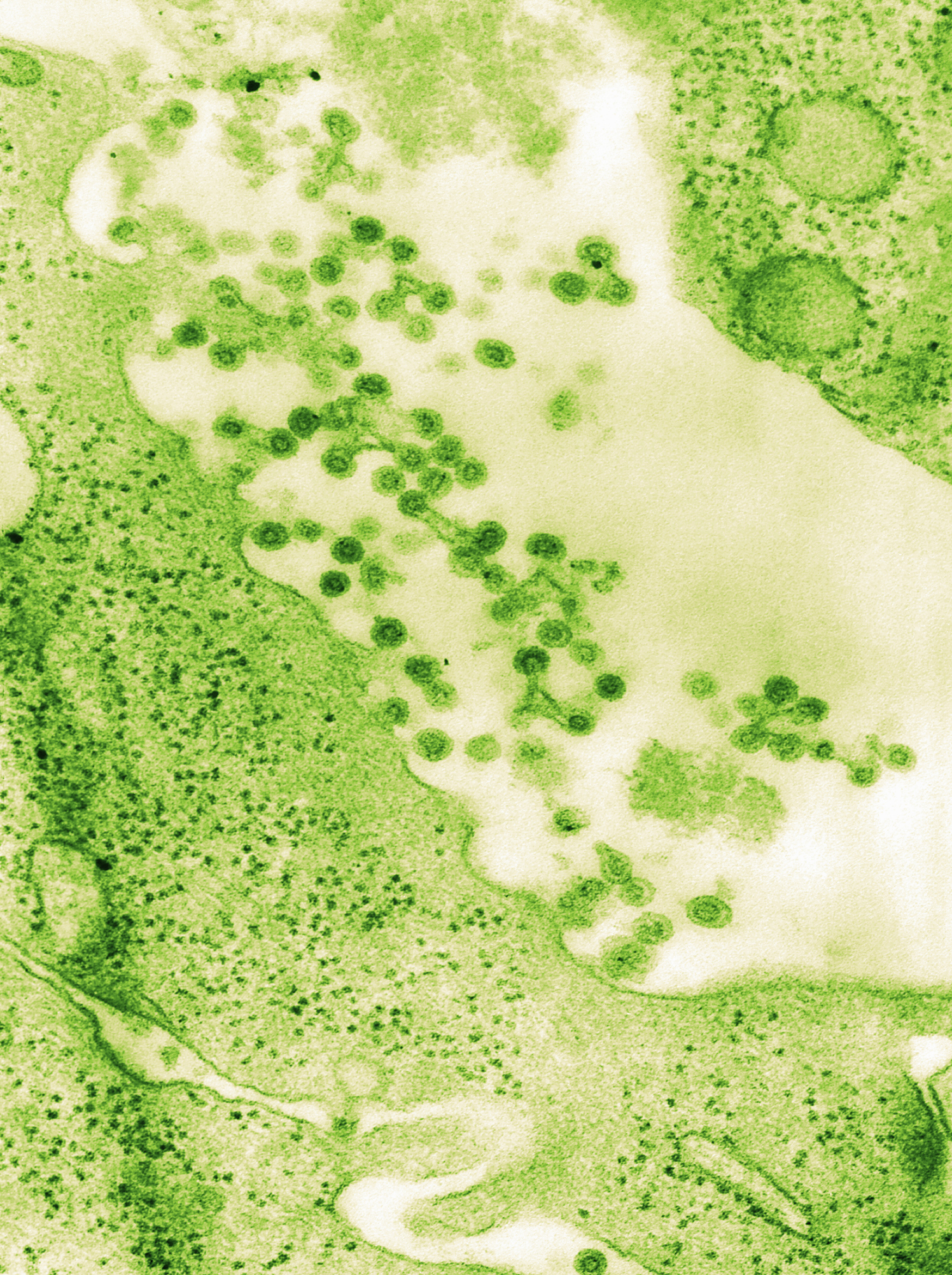 TEM of Rubella virus virions